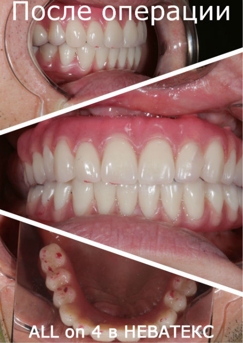 Фото после операции All on 4 в клинике неватекс Фото после операции All on 4